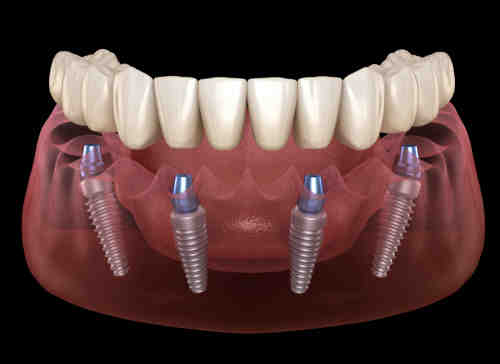 Why do dentists prescribe antibiotics after tooth extraction?