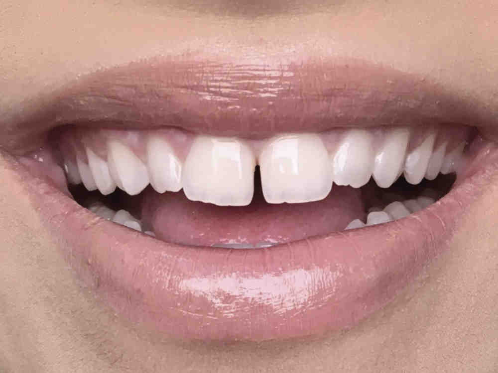 Why Do My Veneers Feel Weird at Juan White blog