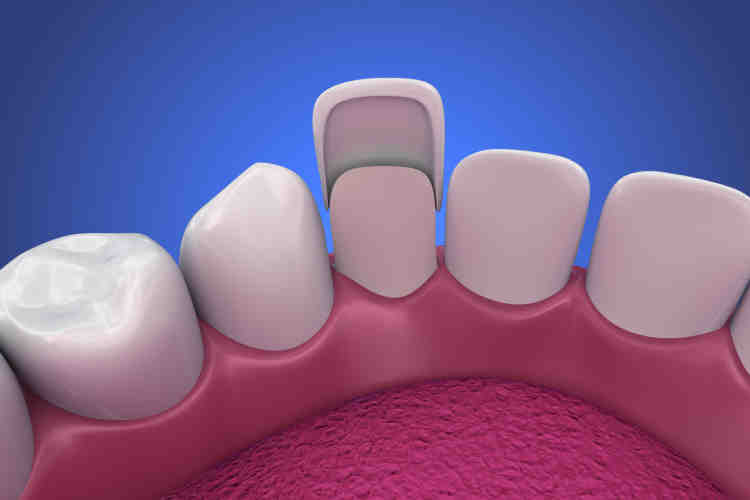 How long does porcelain teeth last? Dental News Network
