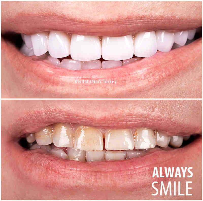 Why do veneers smell?