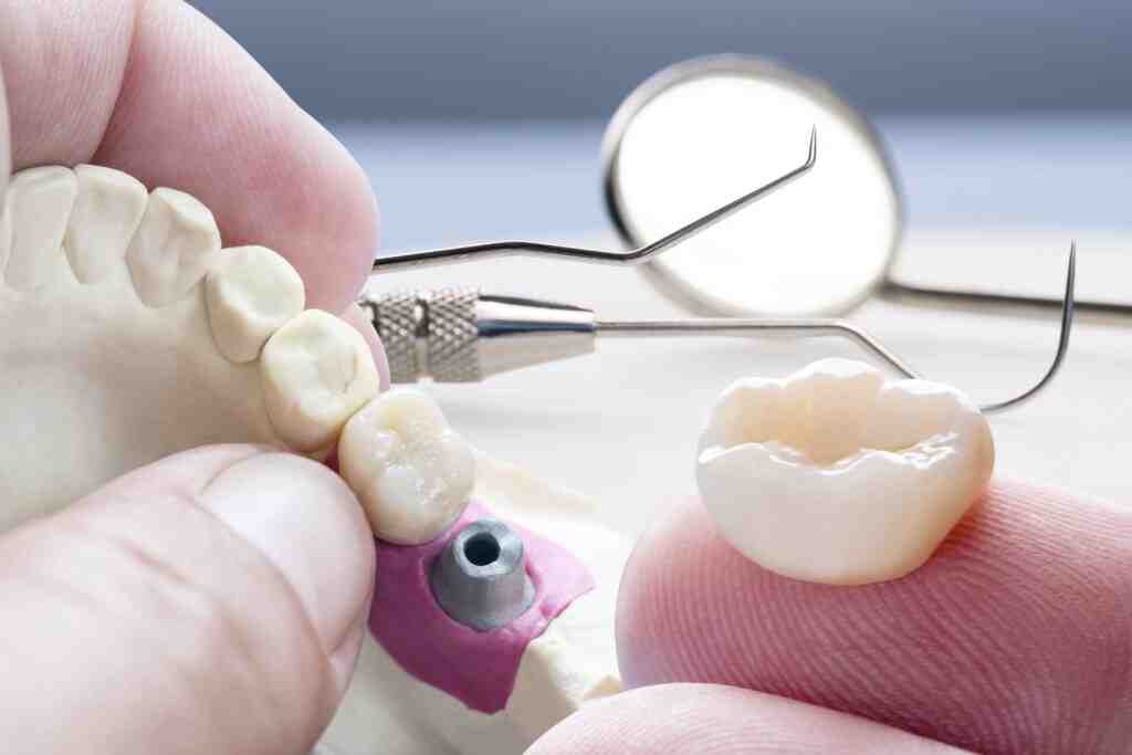 How durable are dental implants Dental News Network