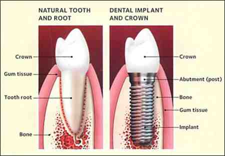 Why does my dental implant hurt when I chew?