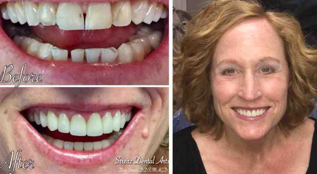 can-a-dental-implant-be-redone-dental-news-network