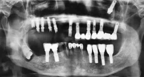 Why does my implant hurt after 2 weeks?