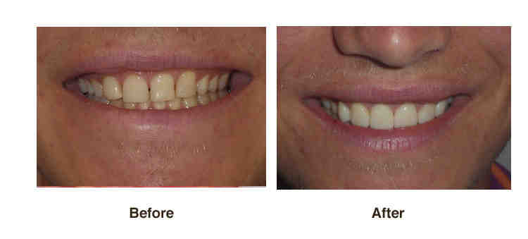 Why is my smile uneven?