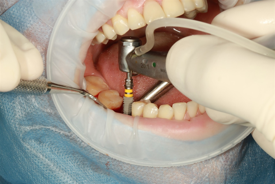 Will Fixodent hold a crown in place?