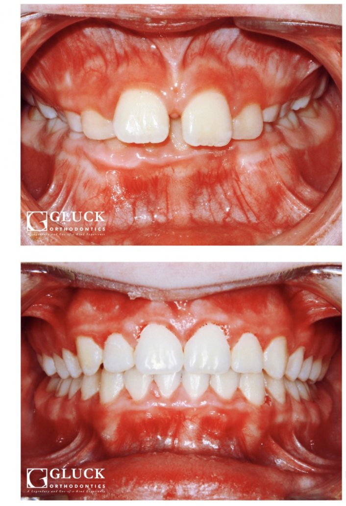 What are cheaper than veneers? Dental News Network