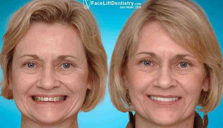 Will dental implants lift my face?