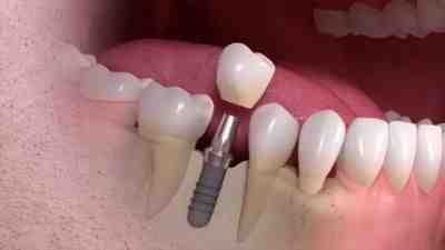 Will removing all my teeth cure periodontal disease?