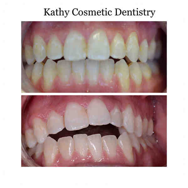 Are braces FDA-approved?