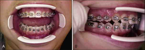 Are braces considered cosmetic surgery?