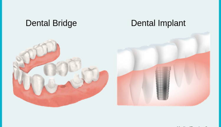 are-crowns-better-than-implants-dental-news-network