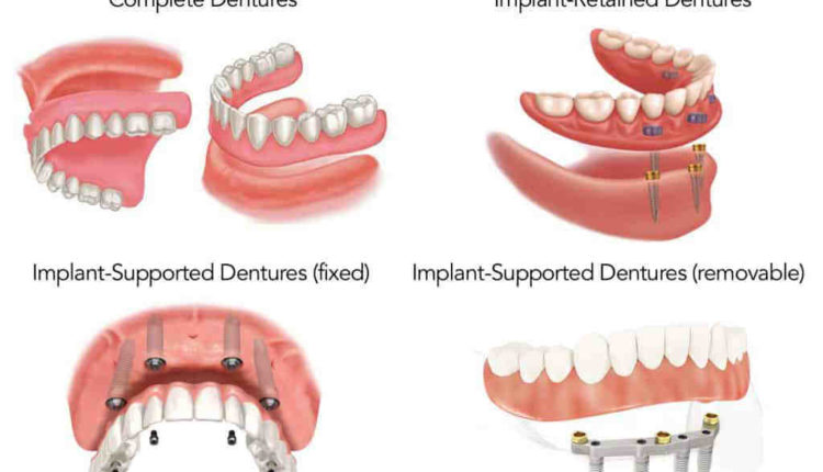 Are dental implants covered by insurance?