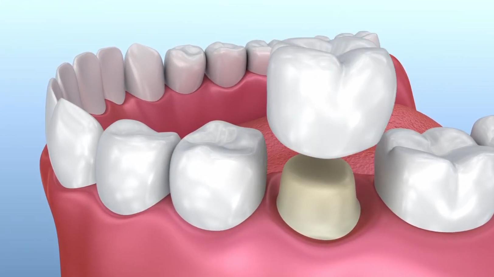 Are porcelain crowns stronger than teeth?