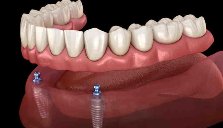 Are snap on dentures the same as implants?