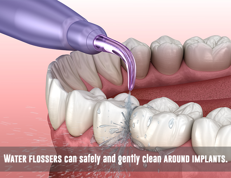 Are veneers worth it?