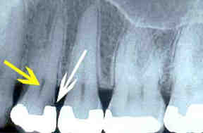 Can I buy antibiotics for tooth infection over the counter?