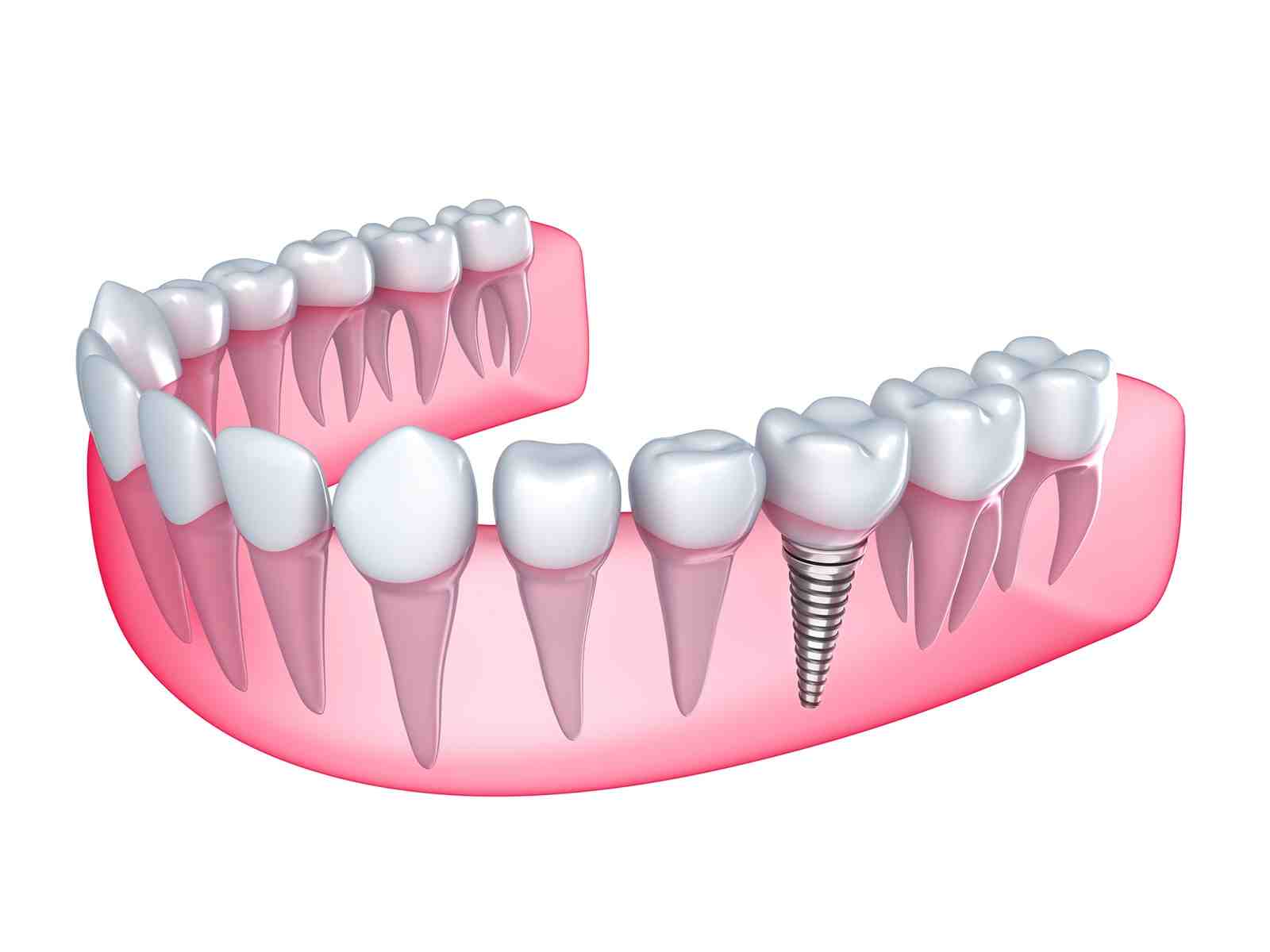 Can I eat chicken after dental implant?
