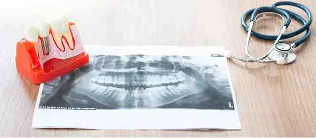 Can I have an MRI with titanium implants?