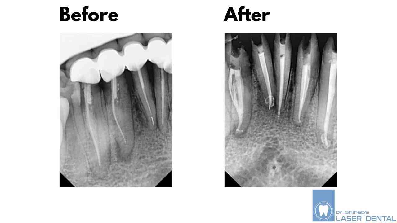 Can I refuse root canal treatment?