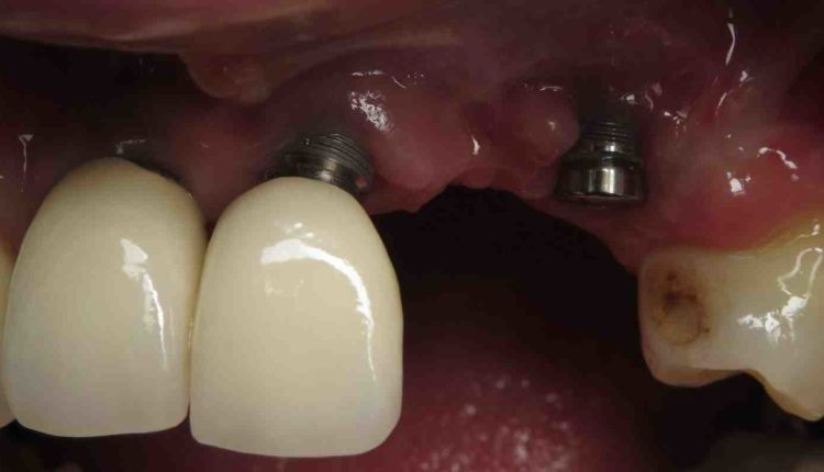 can-a-dental-implant-fail-dental-news-network