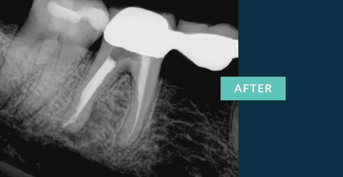 Can a dentist pull an infected tooth?
