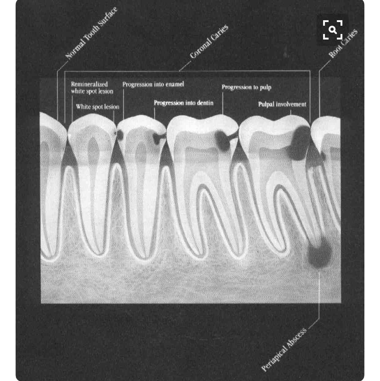 Can a dentist tell from an xray if you need a root canal?