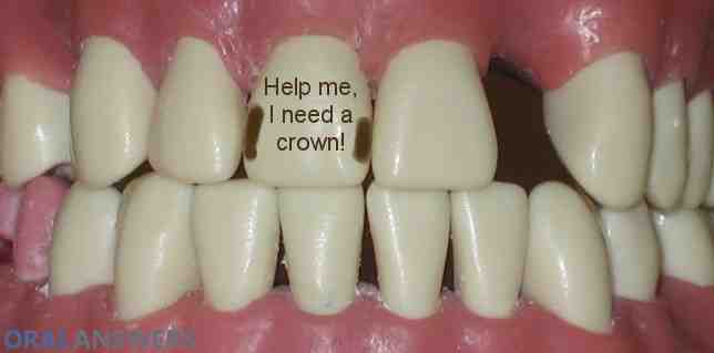 Can a dentist tell if there is decay under a crown?