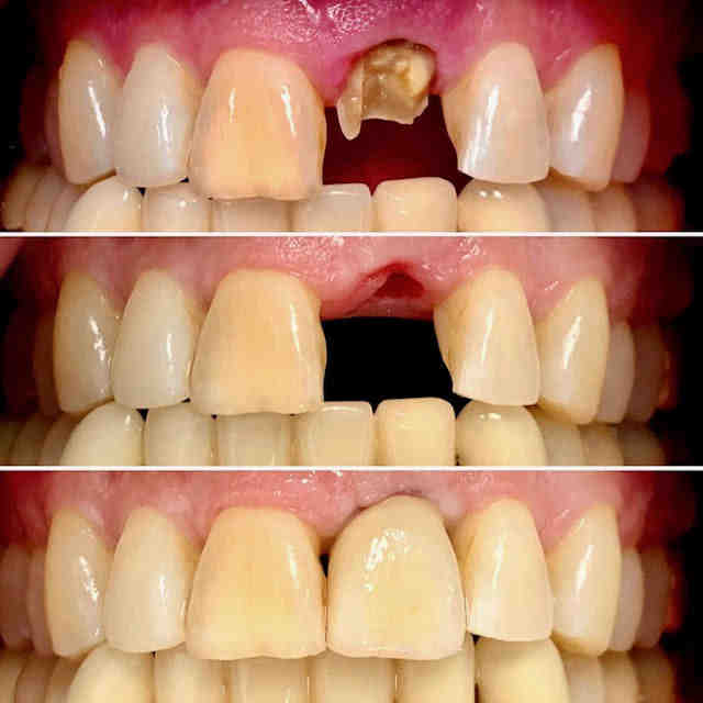 Can a failed dental implant be removed?