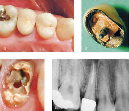 Can a failed root canal affect other teeth?