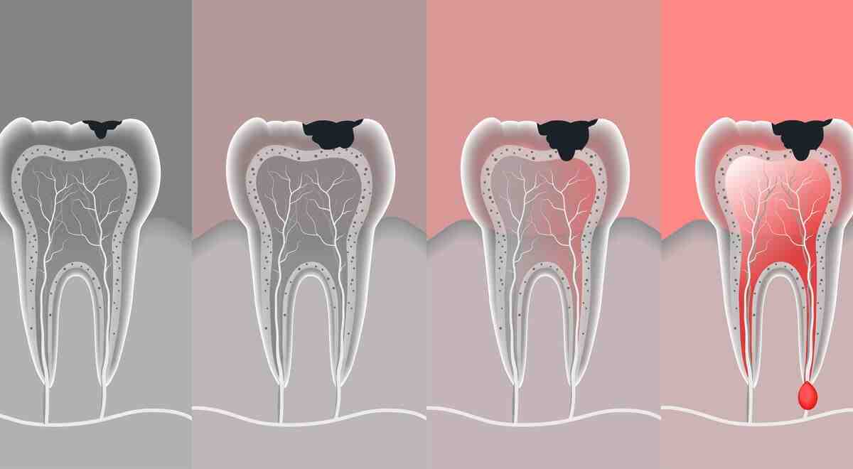 Can a failed root canal make you sick?