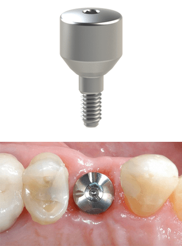 Can a healing abutment fall out?