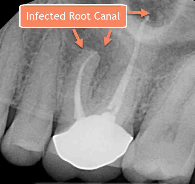 Can A Root Canal Get Infected Years Later Dental News Network 