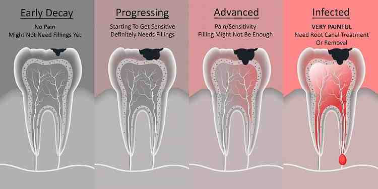 Can a tooth be saved without a root canal?