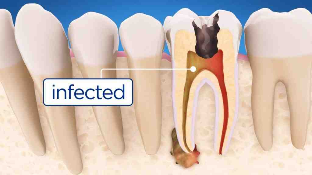 Can a tooth that had a root canal get infected again?