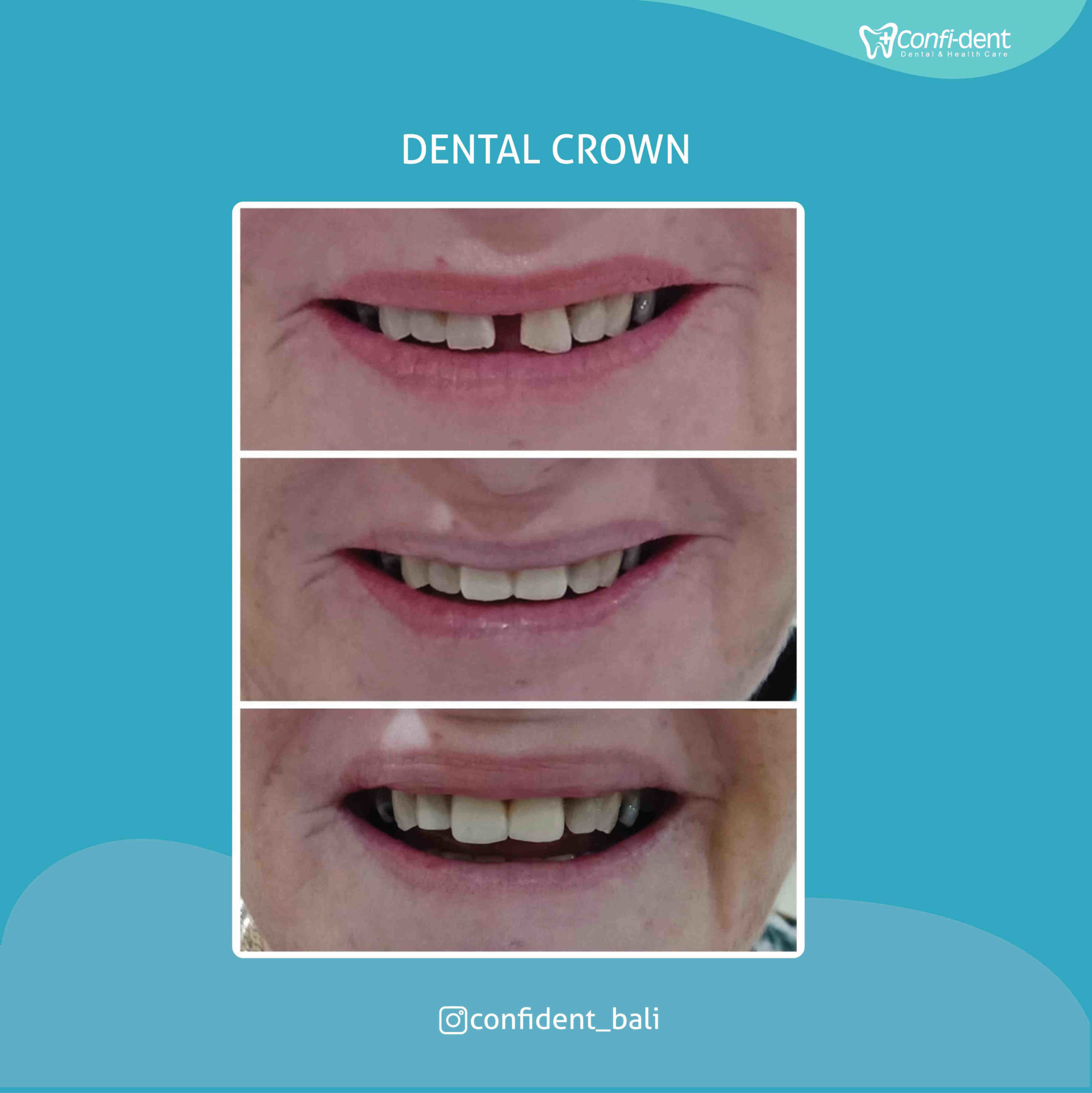 Can a tooth under a crown get infected?