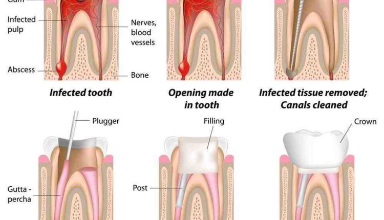 can-a-tooth-with-a-root-canal-hurt-years-later-dental-news-network