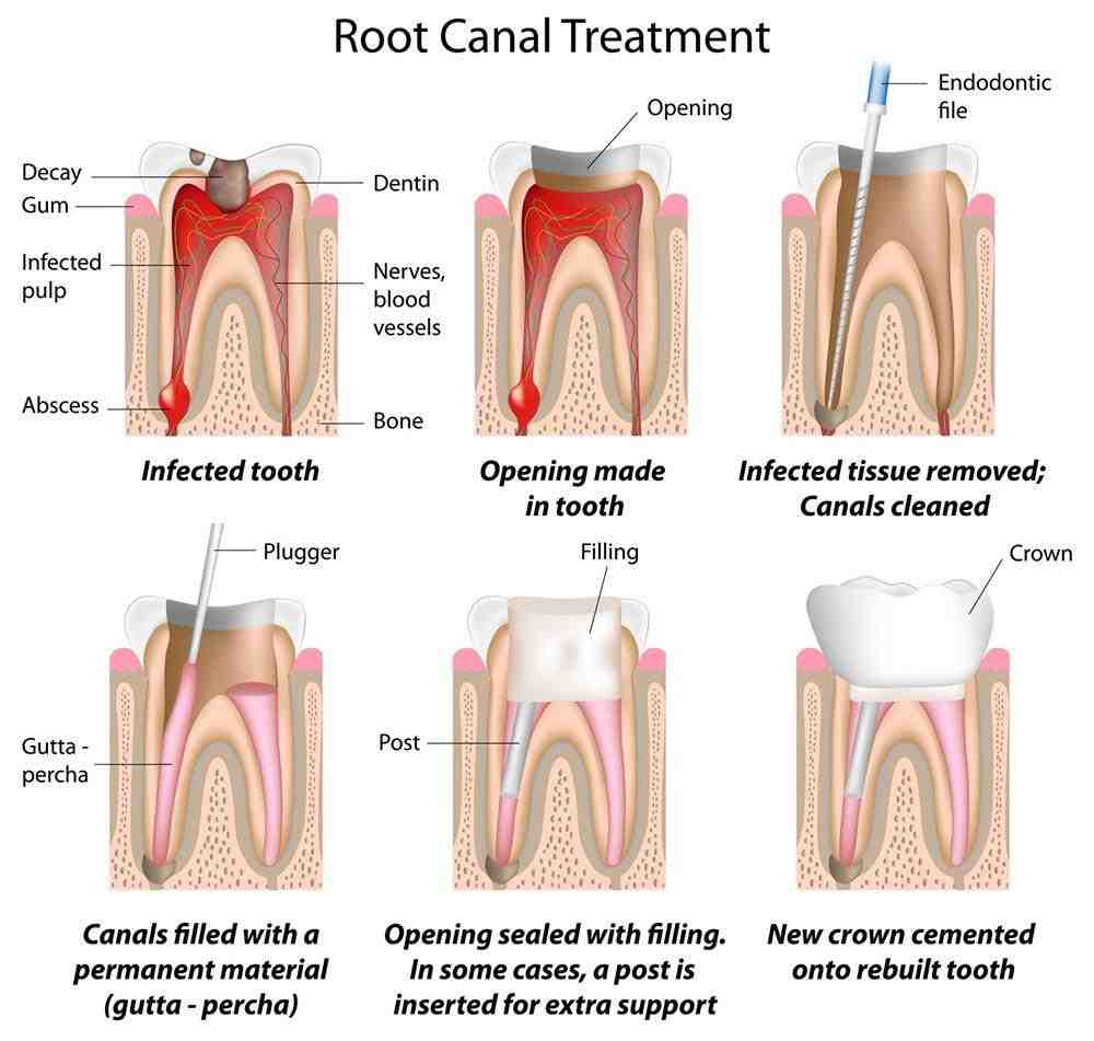 Can a tooth with a root canal hurt years later?