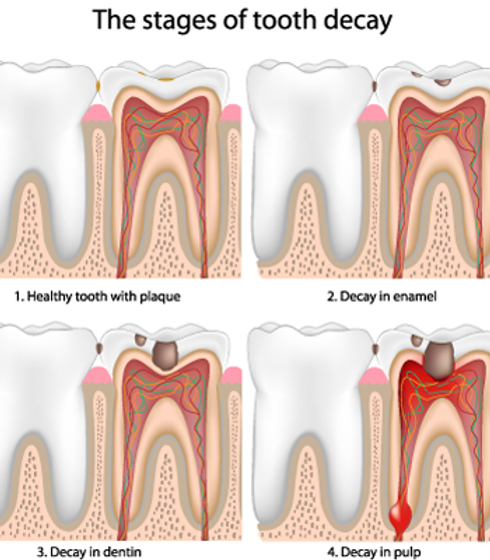 Can antibiotics fix a failed root canal?