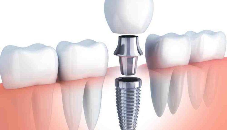 Can be installed dental implants immediately after extraction