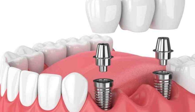 Can dental implant hurt after a few years