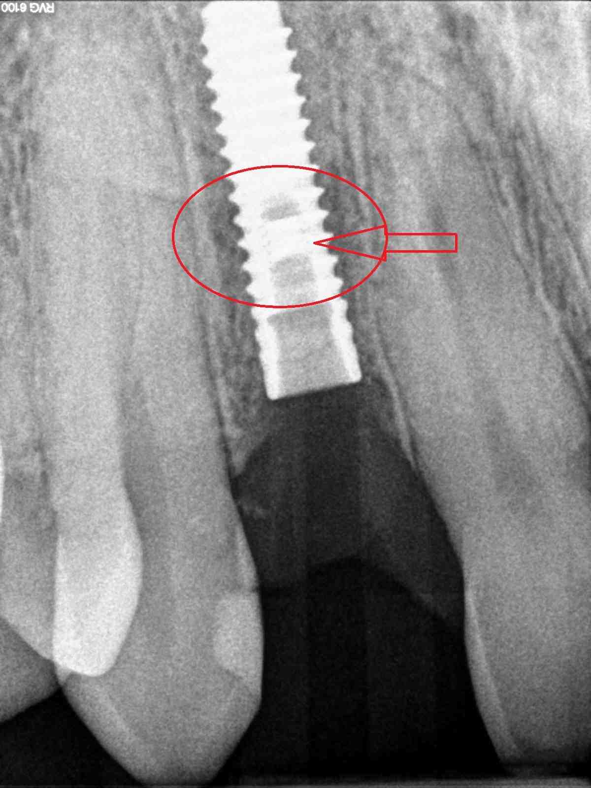 Can dental implant screws be removed?