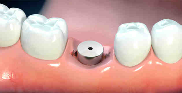 Can dental implants be removed and replaced?