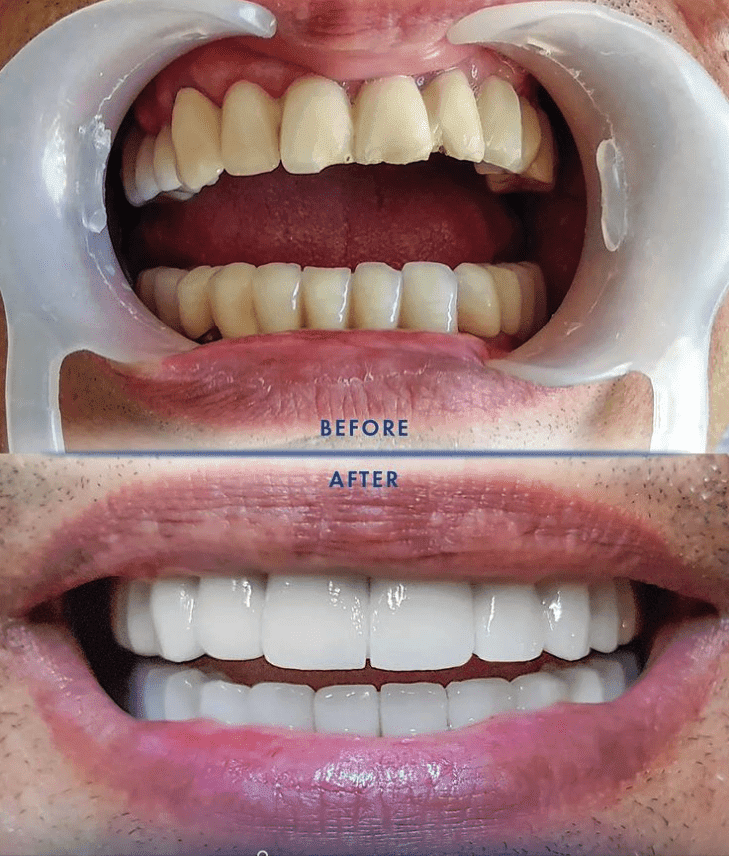 Can dental implants get infected years later?