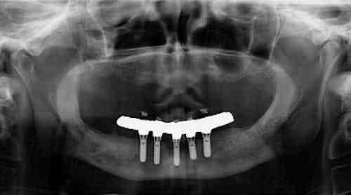 Can dental implants last 50 years?