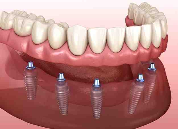 Can dentures stay in permanently?