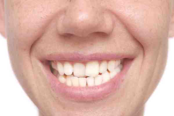 Can fake braces mess up your teeth?