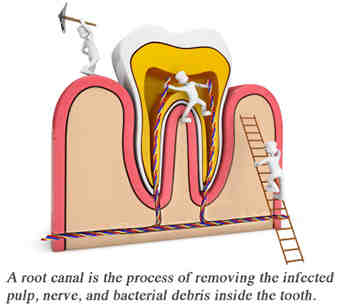 Can root canal treatment be delayed?