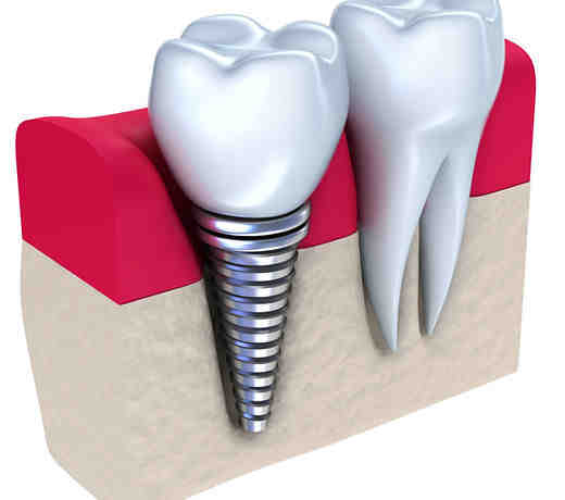 Can titanium implants cause autoimmune disease?
