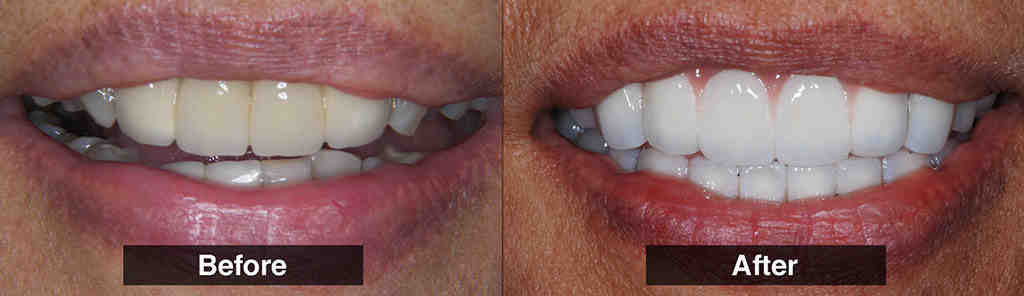 Can yellow teeth become white again?